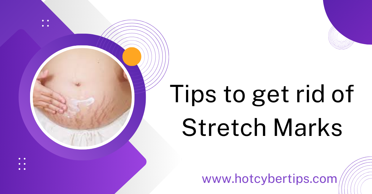 You are currently viewing Tips to get rid of Stretch Marks